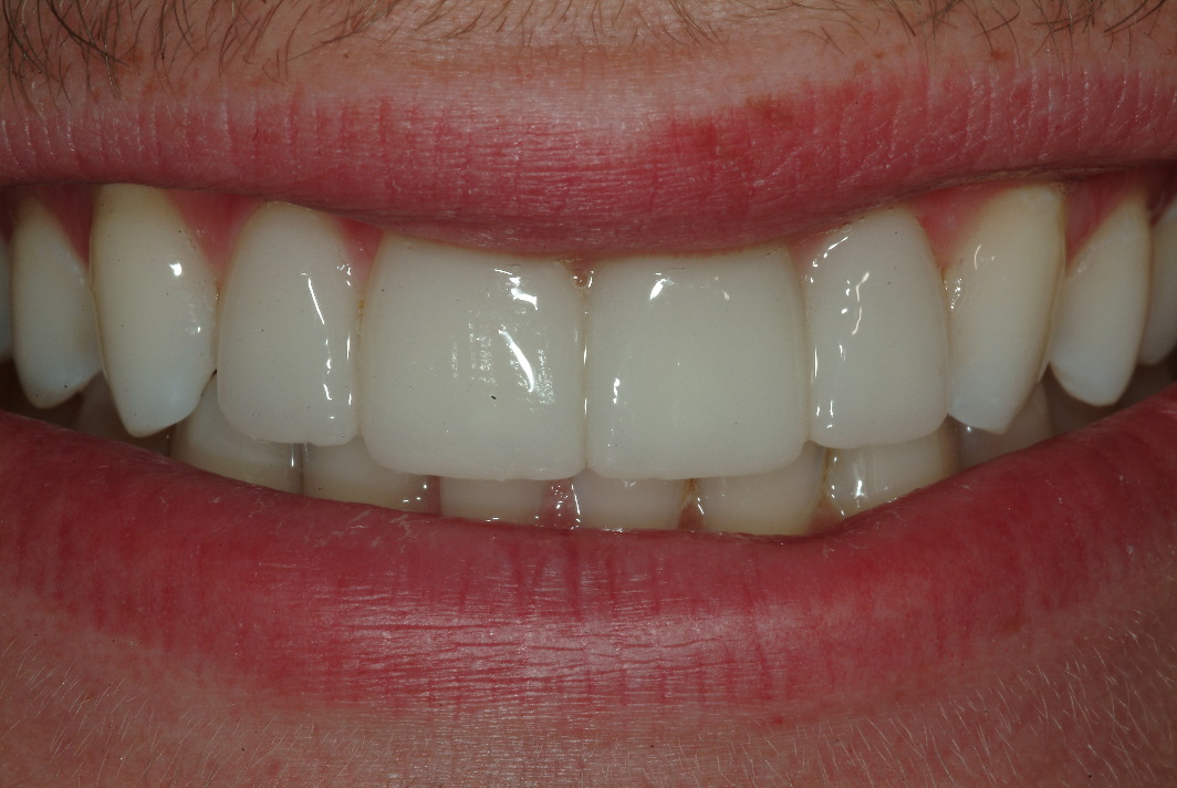 Tooth veneers in North Shore after photo