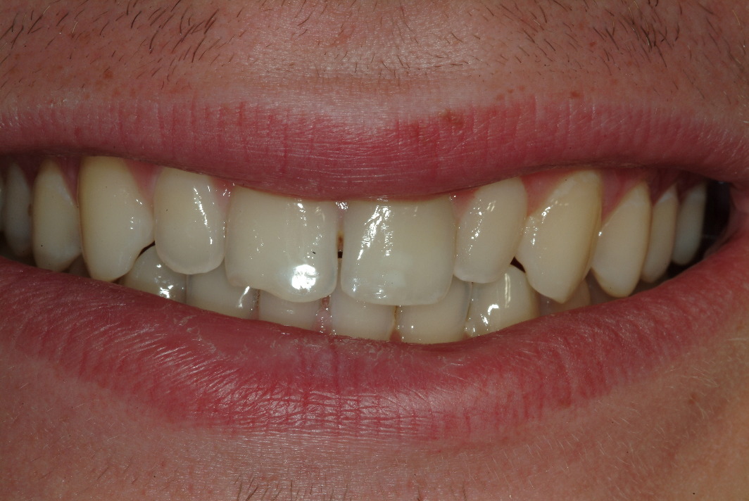 Tooth veneers in North Shore before photo