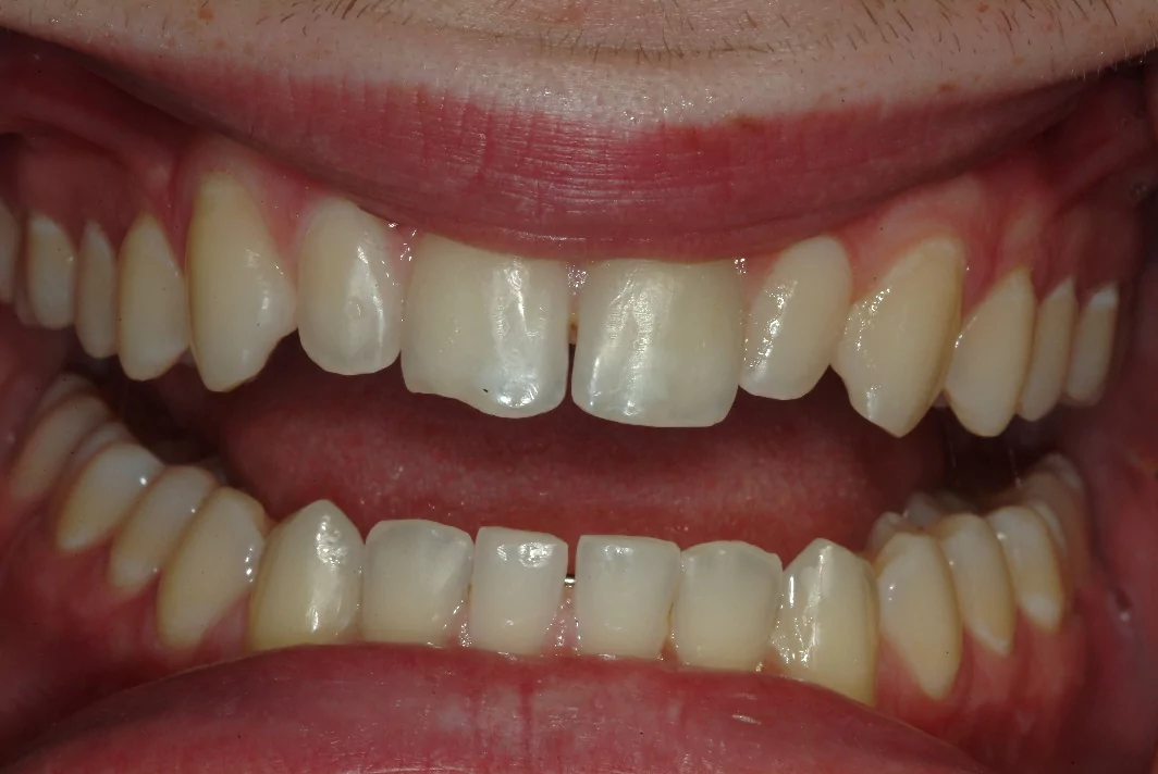 Dental venners for teeth in Evanston before photo