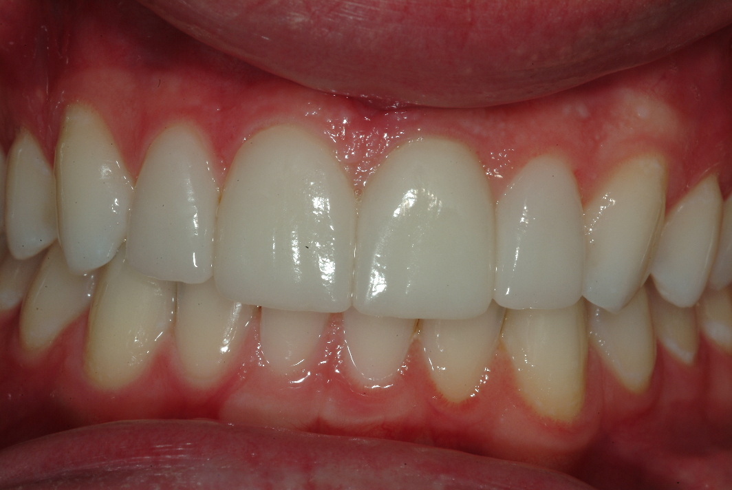 Dental venners for teeth in Evanston after photo