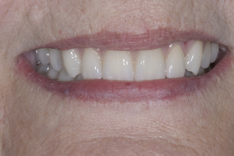 North Shore dentist patient after photo