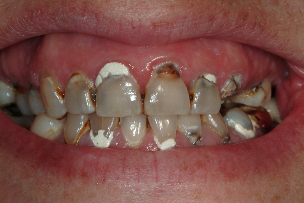 Full mouth reconstruction patient before photos