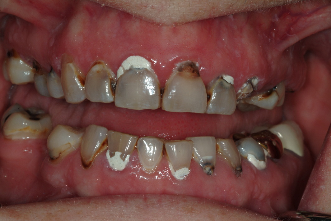 Dental implants and dental crowns patient near Evanston