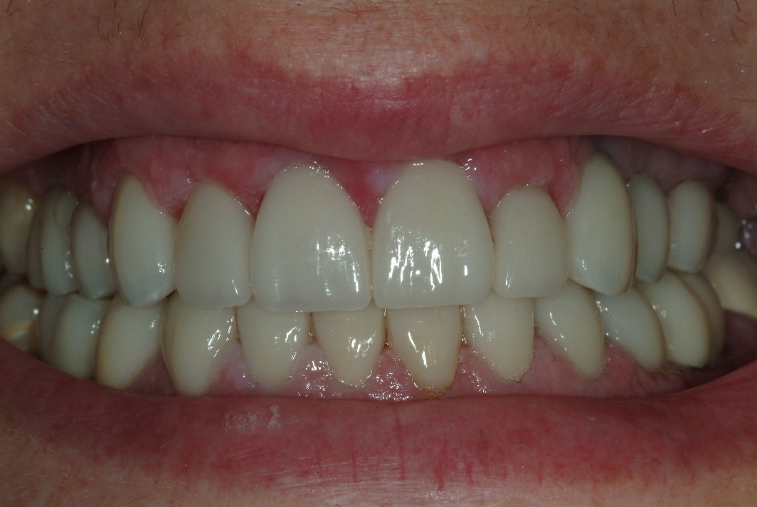 Full mouth reconstruction patient after photos