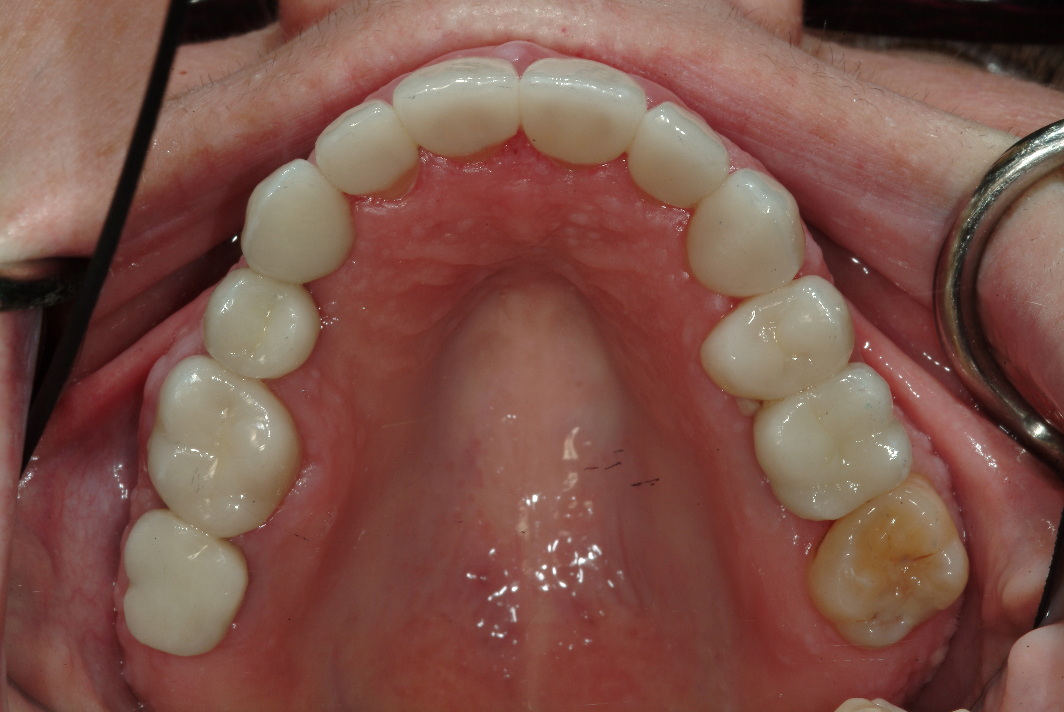 Dr. Mantis performs full mouth reconstruction in Wilmette with crowns and implants