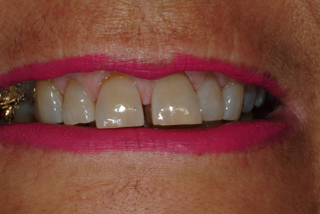 Before dental implants and dental crowns in Wilmette procedure