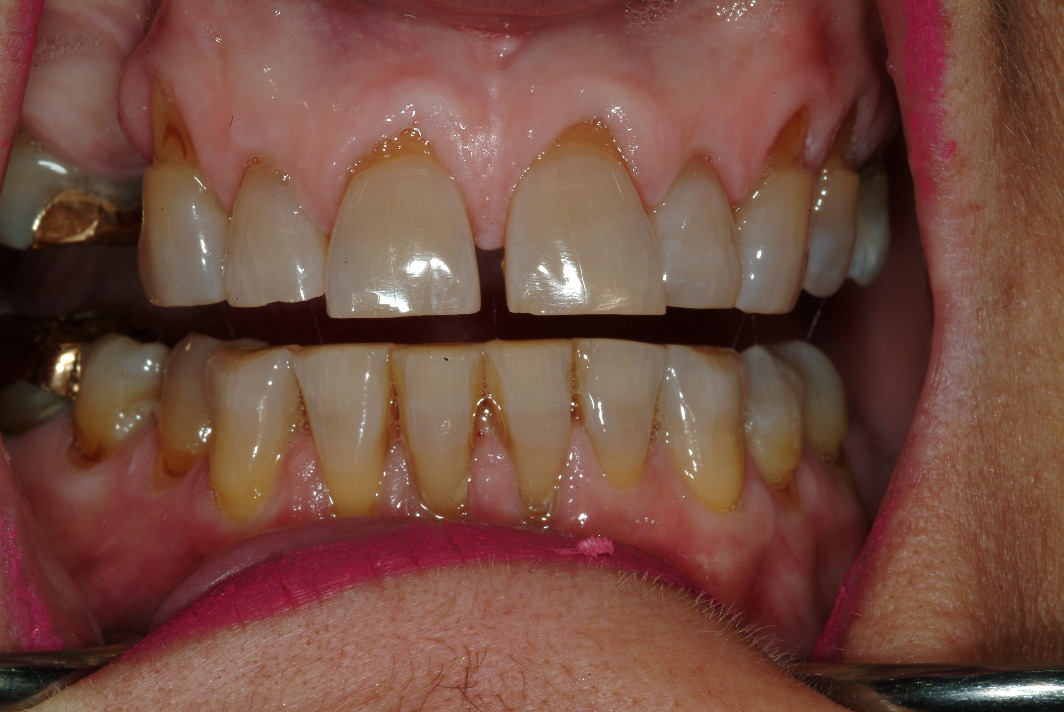 Dr. Dino Mantis dental crowns and dental implants patient before photo