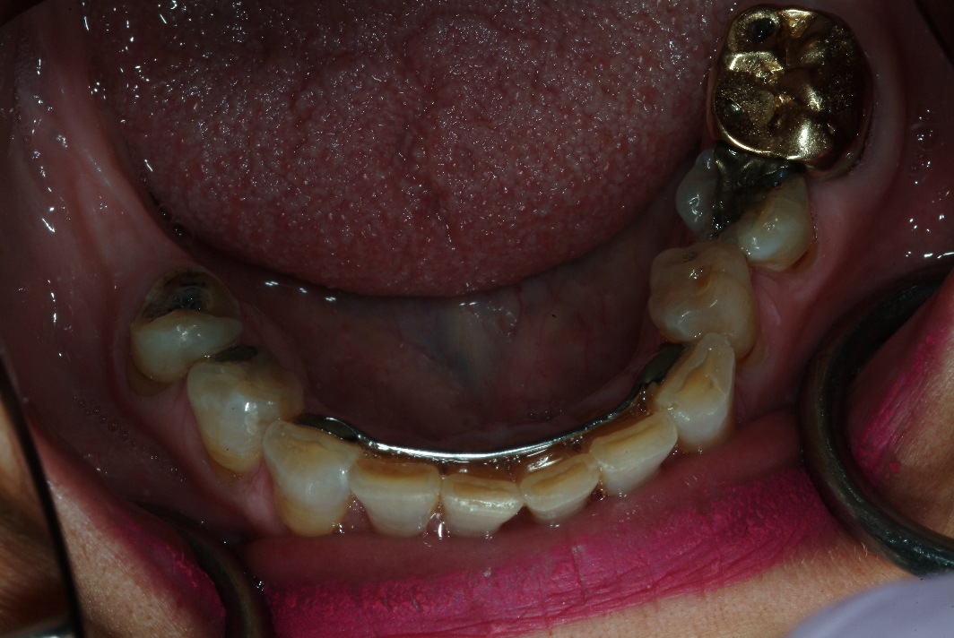 North Shore dental implants and dental crowns patient before photo