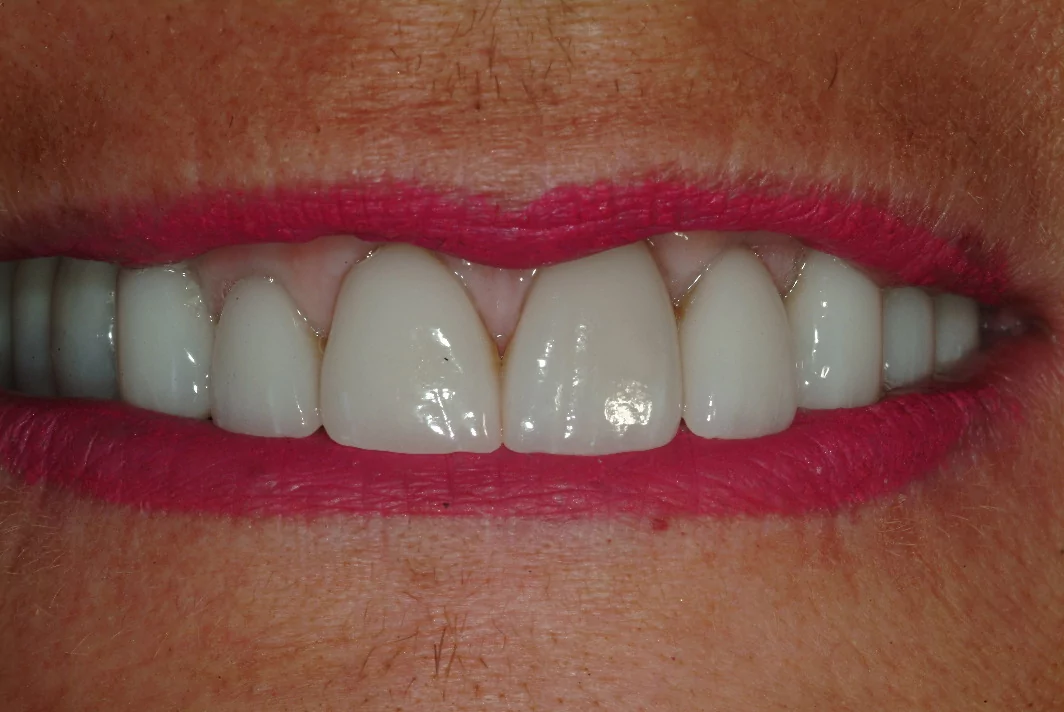 After dental implants and dental crowns in Wilmette procedure