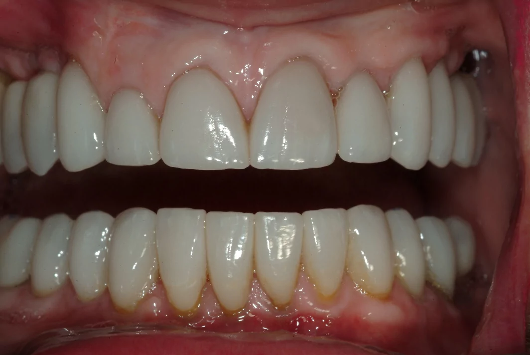 Dr. Dino Mantis dental crowns and dental implants patient after photo