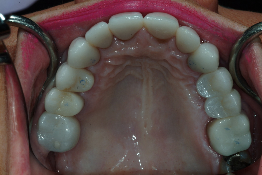 Dental crowns and dental impants in Wilmette after photo