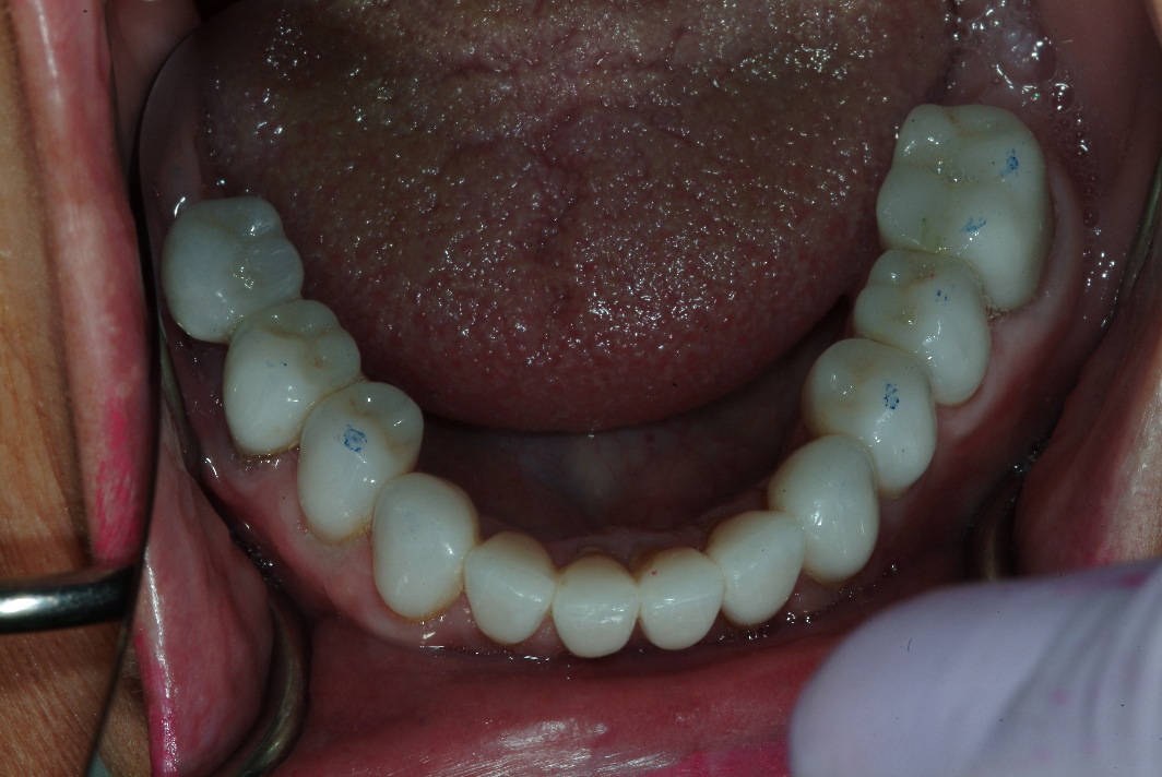 North Shore dental implants and dental crowns patient after photo