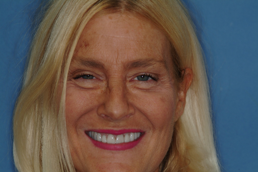 Wilmette dental patient after dental implants and tooth crowns with Dr. Mantis