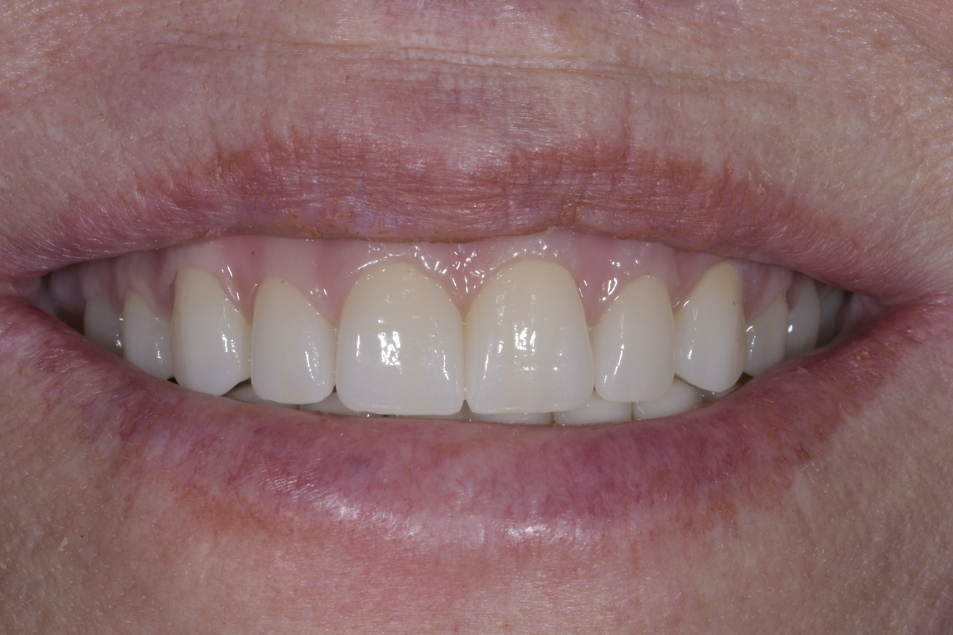 Mantis Dentistry and Implant Center patient after photos