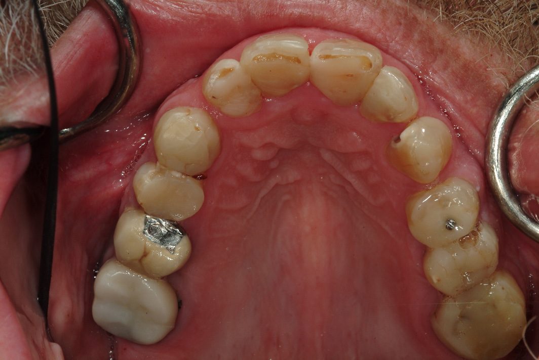 Dental implants near Evanston patient before photo