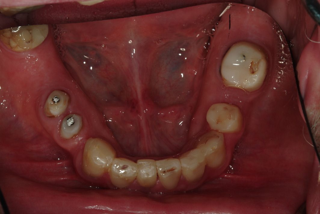 Tooth implants near Evanston patient before photo