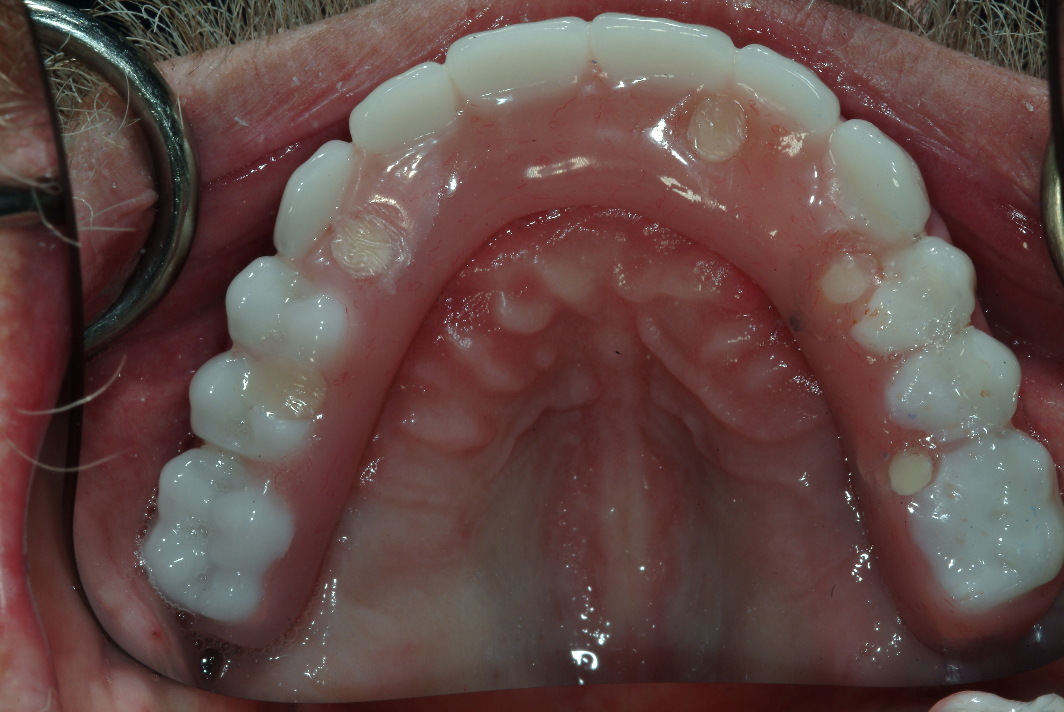 Dental implants near Evanston patient after photo