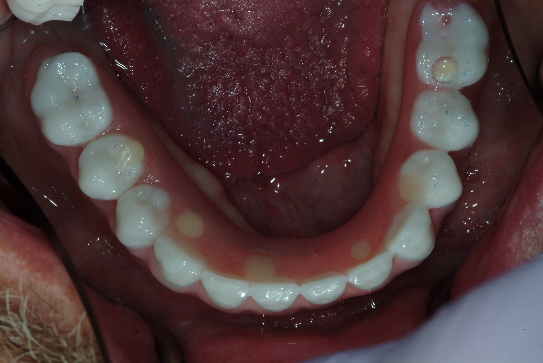 Tooth implants near Evanston patient after photo