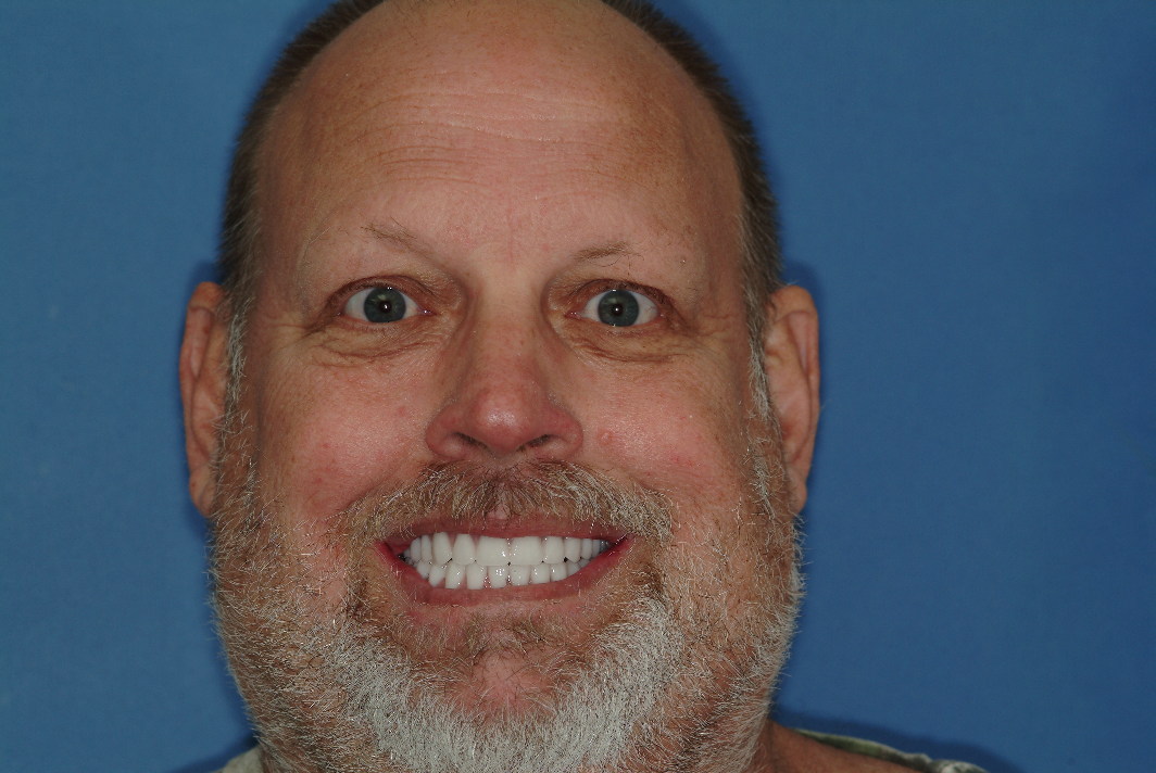 Dental implants patient after photos in Wilmette