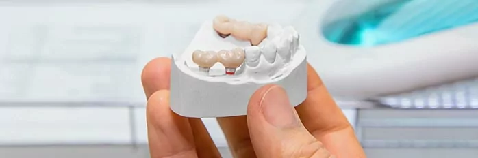 dental bridges services