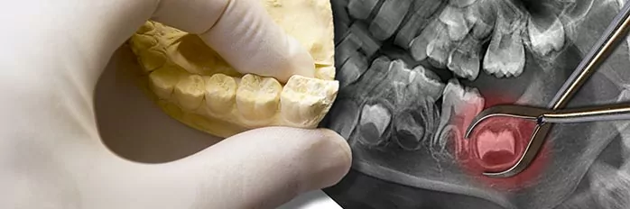 simple & wisdom tooth extractions services