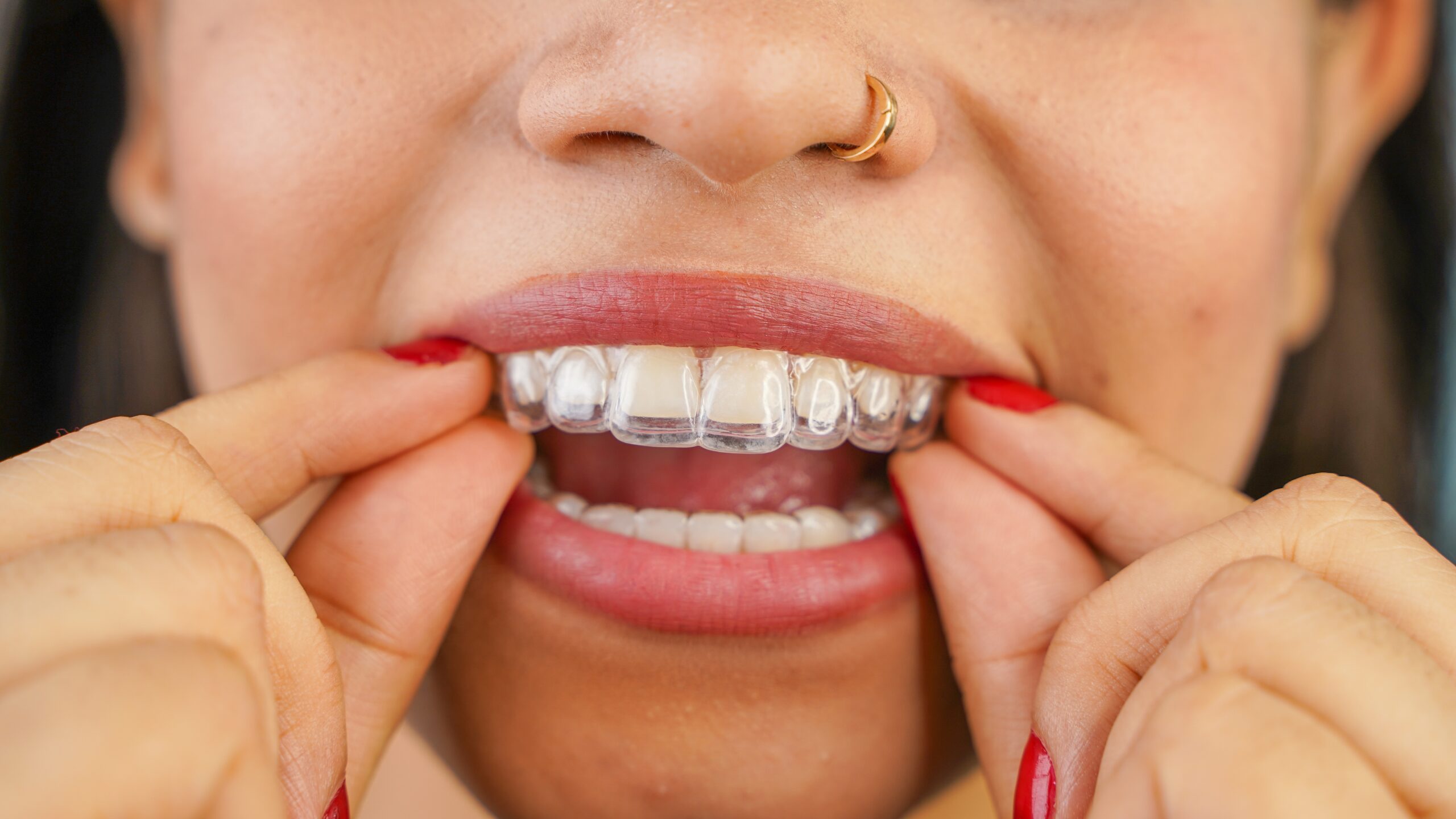 young asian woman placing her clear aligners in